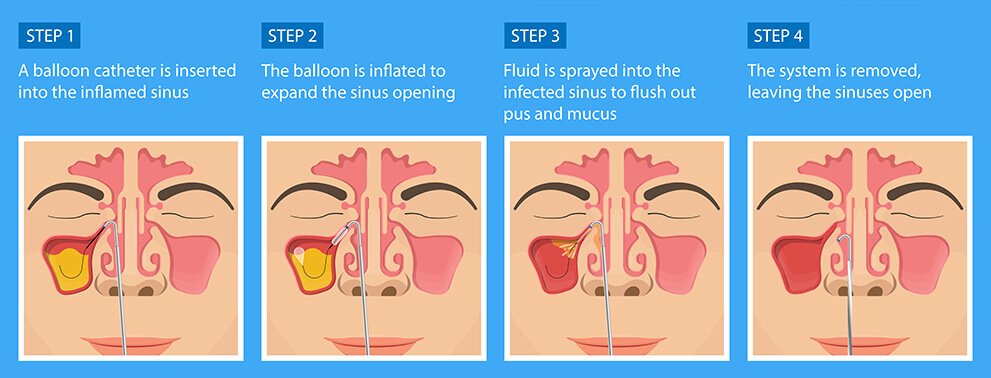 Sinuplastia con Balón