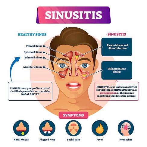 sinusitis sintomas-1